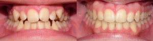brett-before-and-after-intraoral1 (1)